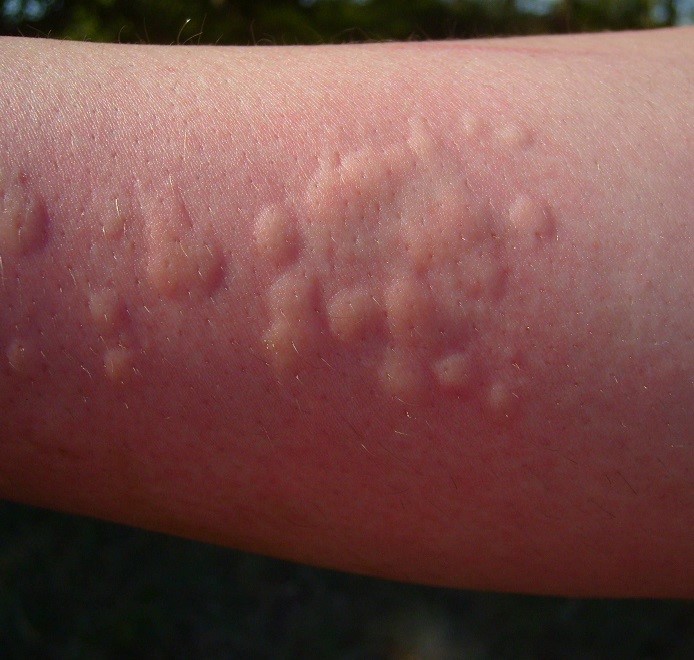 Крапивница - не только аллергия